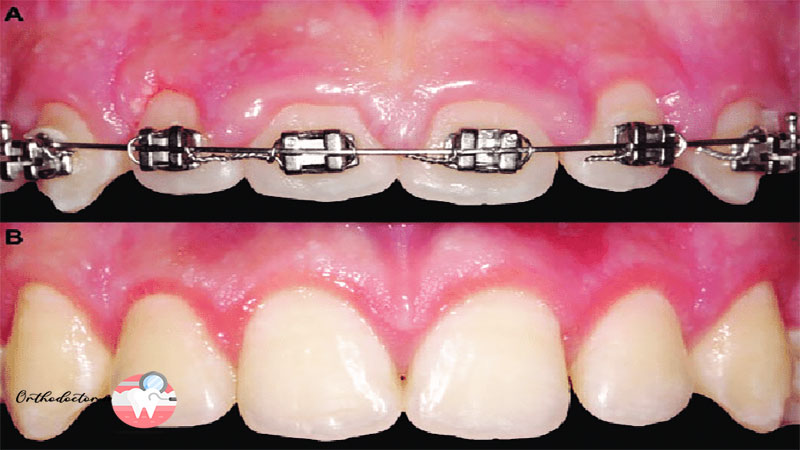 التهاب لثه در ارتودنسی