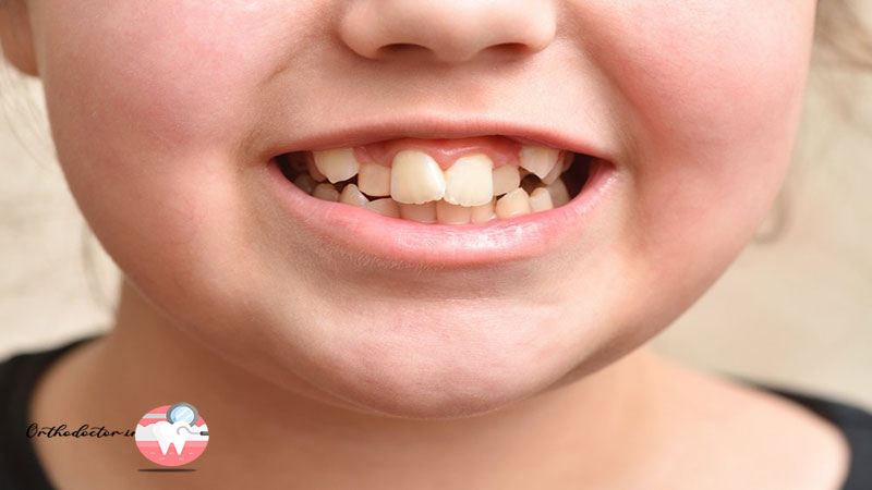 نامرتبی دندان ‌ها در پوسیدگی دندان