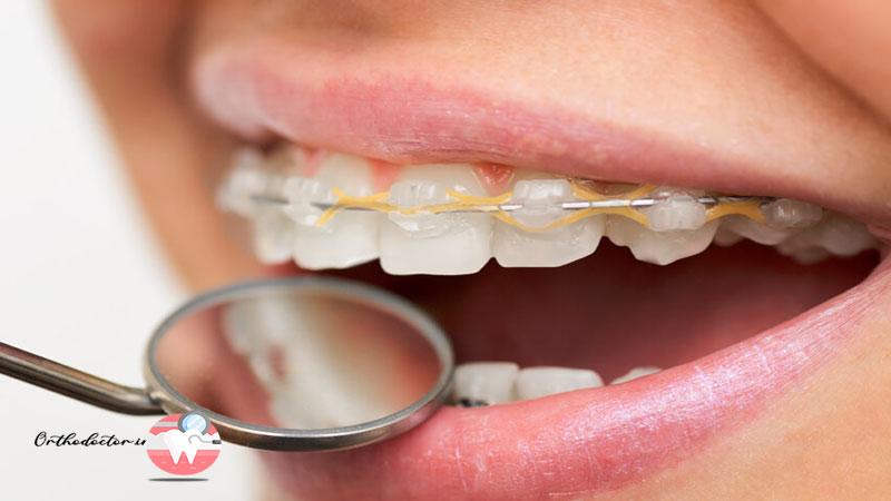 آیا ارتودنسی دندان پر شده امکان پذیر است؟