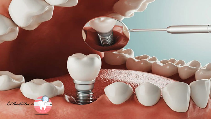 ارزش بلند مدت ایمپلنت های دندانی