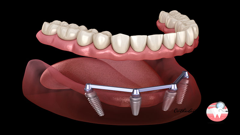 مراحل انجام ایمپلنت کامل دندان
