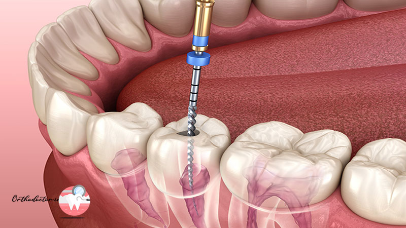 عوامل موثر بر هزینه عصب کشی دندان